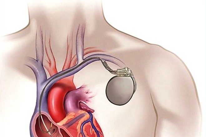 Les hôpitaux de Paris télésurveillent 5000 patients munis de stimulateurs cardiaques